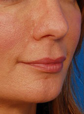 Woman's lips, before Lip Lift and Lip Reduction treatment, r-side oblique view, patient 64