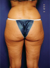 Woman's body, before Liposuction treatment, b-side view, patient 4