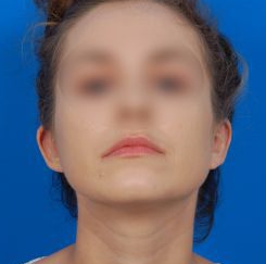 Woman's face, after Ear Surgery (Otoplasty) treatment, front view of head (bend over), patient 12